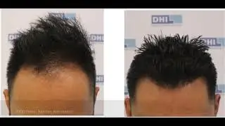 Hair Transplant Results - June 2023 Clinique de Paris