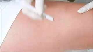 Laser Neodimio - Yag