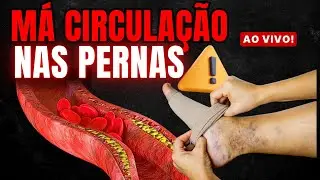 M&Aacute; CIRCULA&Ccedil;&Atilde;O nas PERNAS e P&Eacute;S ( secagem e aplica&ccedil;&atilde;o das varizes, varicose e trombose )