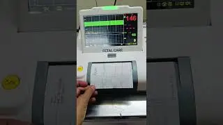 CTG Machine for baby's heartbeat & movement in the womb.#medical #medicallife