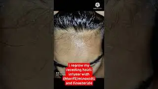 improve hair density and regrow hair in hairline area#shorts