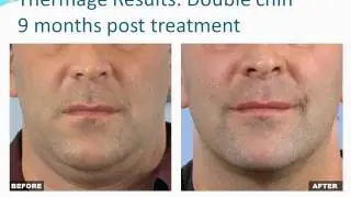 Skin Tightening with Thermage