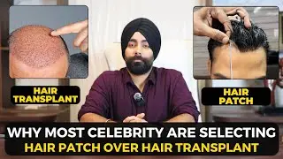 Hair Patch vs Hair transplant | Why most celebrity are choosing hair patch  | Hair wig house