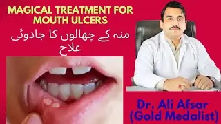 Mouth Ulcers Treatment|Mouth Ulcers Causes and Homeopathic Treatment| Munh Ke Chhalon Ka Ilaj|