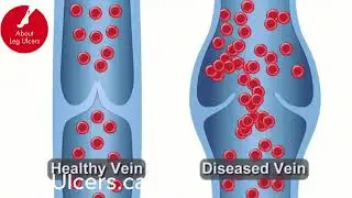 How to heal Your Venous Leg Ulcers Using Compression!