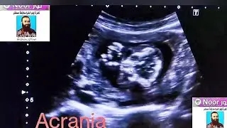 Acrania // fetal bone // open skull // cranial bones // ultrasound video