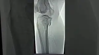 Fluoroscopy guided embolectomy for artery blockage