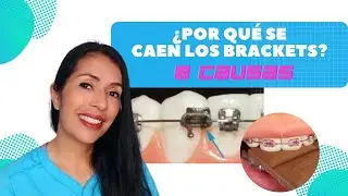 ¿Por qué se caen los brackets?.  8 causas😲