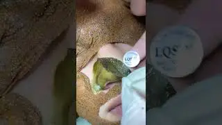 face mask cream removal #maskremoval #peeloffmask #blackheadremoval #satisfying