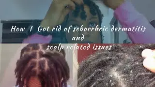 How I got rid of seborrheic dermatitis symtoms| dandruff| flakes| itchy scalp| redness of scalp