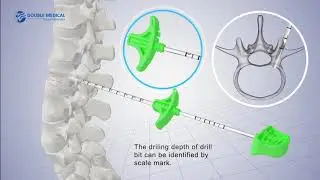 Double Medical Percutaneous Kyphoplasty System
