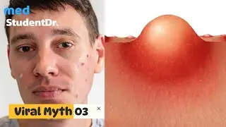 Stop Putting Toothpaste on Your Pimples! -Based on Science | Med Myths Busting With MedstudentDr.