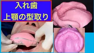 上顎の型取り　総入れ歯の作成①