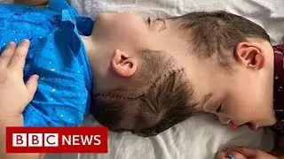 Conjoined twins separated with the help of virtual reality - BBC News