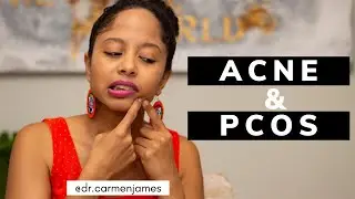ACNE AND PCOS// 6 TIPS FOR CLEAR SKIN// HOW TO REDUCE ACNE WITH POLYCYSTIC OVARIAN SYNDROME