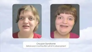 Craniofacial Syndromes, Dr. Pat Ricalde