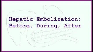 Hepatic Artery Embolization for Neuroendocrine Liver Metastases