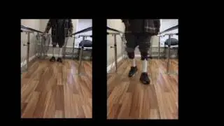 Ray Diaz Patient Success -  Bilateral Phat braces