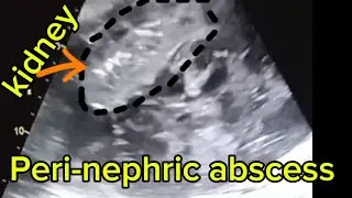 Peri-nephric abscess in ultrasound.