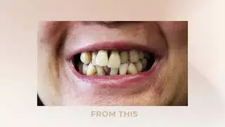 Rodilyn's Full Mouth Reconstruction | Angela Leung DDS PC