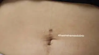 Belly Button piercing scar treatment - Basma Hameed Clinic