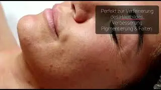 Mezotix Behandlung Hautstraffung, Anti Aging, Pigmentfleckenverminderung&Verbesserung von Narben