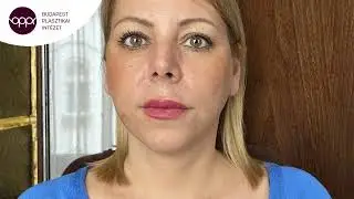 Andi arcplasztikai beavatkozása dr. Sobor Györgynél - EREDMÉNNYEL