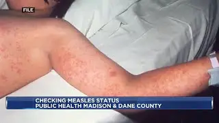 Wisconsin health experts encourage travelers to check vaccination status ahead of Spring Break