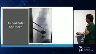 Pedicular Approach to Vertebral Augmentation - Neal Shonnard, MD