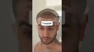 Hair transplant transformation 8 months after surgery! #hairtransplant #fue #turkey #hairgrowth
