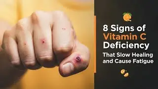 8 Signs of Vitamin C Deficiency That Slow Healing and Cause Fatigue