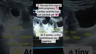 🌸 5 Weeks Pregnancy Scan | Tiny Gestational Sac Visible 🍼✨ #ultrasound #baby