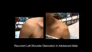 Interscalene Nerve Block for Lt. Shoulder Dislocation in Adolescent