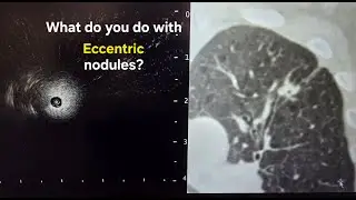 Простая схема дыхательных путей! (Этапография ветвей бронхов) Левая верхняя доля LB1+2