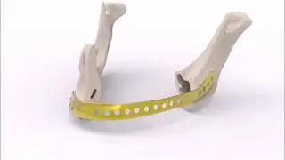 Reconstrucci&oacute;n mandibular con placas anat&oacute;micas