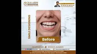 Smile Designing In Kumbakonam #Nalammdentalhospital #kumbakonam #kumbakonamdentist #smiledesigning