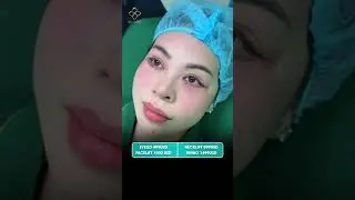 Double Eyelid Surgery for Bigger, Clearer Eyes #skincare #eyelid #plasticsurgery #eyelid #facelift