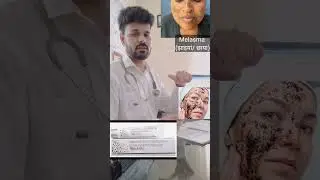100% Effective 🔥 melasma treatment at home #skincare #melasma