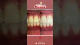 Teeth Bleaching Procedure @ Novocare!