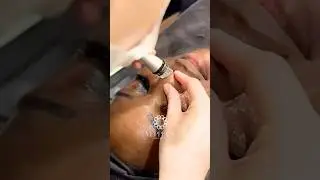 BB SHINE | SKIN CLINIC IN DUBAI #acnecare #cloggedpores #glowingskin #glow #deepcleansingfacial #uae