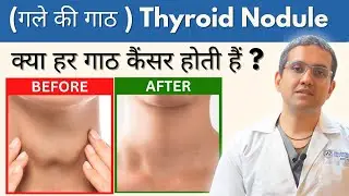 Thyroid Goiter Treatment Without Surgery | Laser & Angiographic Treatment | Dr Gaurav Gangwani