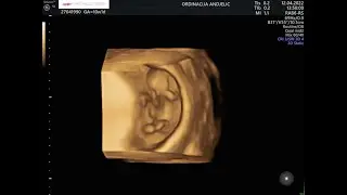 Dr Mirjana Anđelić – 11 nedelja trudnoće. Ekspertni ultrazvuk i vođenje trudnoće