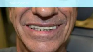 Restoration Dentistry done in Canyon Dental , Corona, California 92881.
