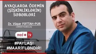 AYAQLARA QULLUQ - ÖDEMİN SEBEBLERİ - ŞİŞKİNLİKLƏR -Dr. Vuqar FETTAH-PUR Cərrah-Fleboloq MEDPLUS