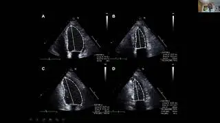 Philips Echo Webinar Series Heart Failure & Fallacies in Echo Assessment by Dr  C K  Ponde, Hinduja