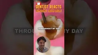 Removing Tooth Decay 🦷 - Dentist Reacts! #shorts #dentist #reaction