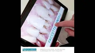 Faccette Dentali -  Napoli