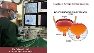 Prostatic Artery Embolization : Treatment for enlarged prostate : Dr. Vikash Jain