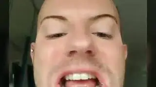 Liam Abram using Invisible Aligner for Teeth Straightening