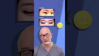 Asian Eyelid Surgery Before and After